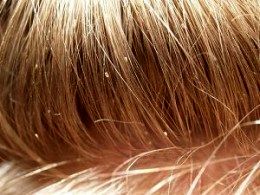 نگاهی به گسترش شپش در مدارس شمال شهر